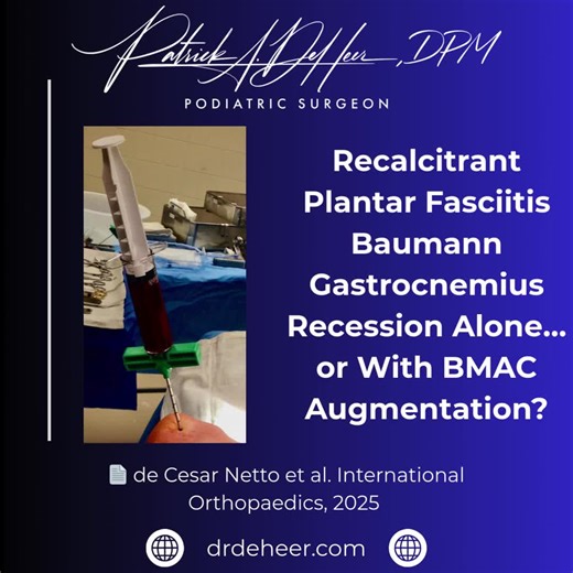 When plantar fasciitis becomes truly recalcitrant, the question is no longer “what injection should I try next?” The question is why the plantar fascia continues to fail under load. In most chronic cases, the answer is persistent gastrocnemius equinus. That is why isolated gastrocnemius recession, including the Baumann technique, has become my preferred operative solution for recalcitrant plantar fasciitis. It addresses the biomechanical driver rather than attacking the fascia itself. So, where 