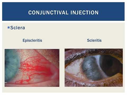 Why Does the Eye Get Red?