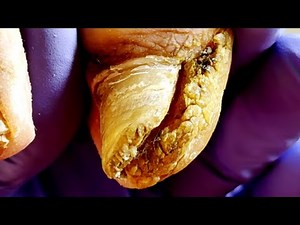 There Are Thick Calluses Around The Toenails, So Trim Them Carefully【Podiatry Clinic】