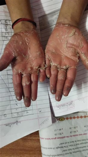 ✨Dr Iram Khan ✨ on Instagram: "🦶 Palmoplantar Psoriasis (PPP) A chronic inflammatory skin condition affecting palms & soles. 🔍 Key Features Thick, well-defined hyperkeratotic plaques Dry, cracked, painful skin Silvery scales may be present Bilateral involvement common Often worsens with friction, detergents, smoking 🧪 Differential Diagnosis Chronic hand/foot eczema Tinea manuum/pedis Hyperkeratotic dermatitis Keratoderma 💊 Treatment Line Topical: High-potency steroids (Clobetasol) Calcipotri