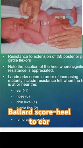 Ballard score-heel to ear