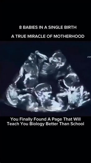 Explaining Biology on Instagram: "8 babies growing together in one womb... This isn’t just rare - it’s one of the greatest miracles of motherhood. An octuplet pregnancy happens when a mother carries eight developing babies at the same time. Inside her womb, these tiny hearts share space, nutrients, and a journey that pushes the limits of human biology. It’s a high-risk, high-care pregnancy - but when all babies survive, it becomes a moment written in medical history. A beautiful reminder of how 