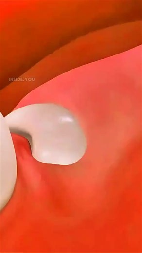 33K views · 178 reactions | This is How Wisdom Tooth Extraction is Done #wisdomtooth #toothextraction #wisdomteethremoval #toothsurgery #dentalprocedure | PurelyFit | Facebook