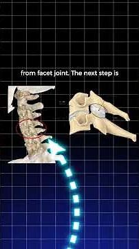 Is Facet Joint Arthritis Causing Your Chronic Neck Pain & Headaches?