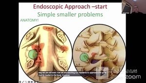 Transforaminal Endoscopic Approach - Endo-LIF Procedure
