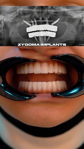 zygoma implants #atomclinic #dentist #smiledesigndental #smile #dentalartistry #smilemakeoversusa