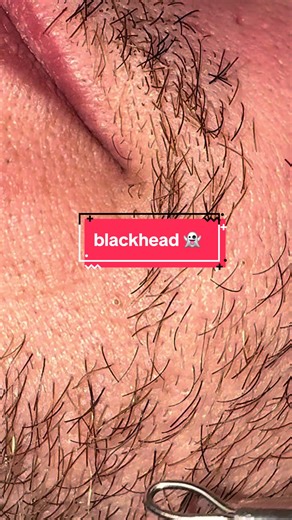 Massive Blackhead Extraction ASMR