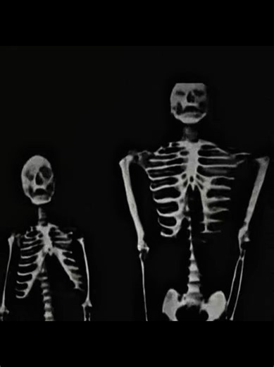 Achondroplasia is the most common form of disproportionate short stature, a genetic condition occurring in approximately 1 in 25,000 live births caused by a specific mutation in the FGFR3 gene on chromosome 4. This mutation results in an overactive fibroblast growth factor receptor, which abnormally inhibits the transition of cartilage to bone in the growth plates, primarily affecting the long bones of the arms and legs. While the condition is inherited in an autosomal dominant fashion, roughly 