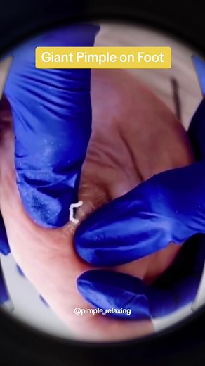 😳 #blackheads #supersatisfying #extractionsatisfaciton #pimplepop