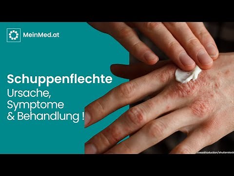 Behandlungsmöglichkeiten bei Schuppenflechte - Tipps und Therapien für eine gesunde Haut