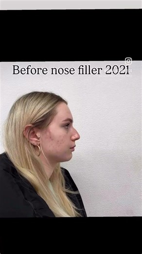 Your nose won’t get bigger over time 👃