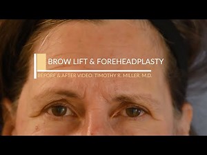 Brow Lift and Foreheadplasty