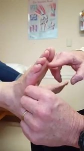 2.7K views · 194 reactions | Clinical Tests for Plantar Plate Tears...