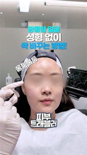 뼈 안 깎고 10분 만에 옆광대 툭 튀어나온 거 없애는 법👇 #피부과시술 #피부과전문의 #피부과 #땅콩형얼굴 #필러 #얼굴형 #shorts