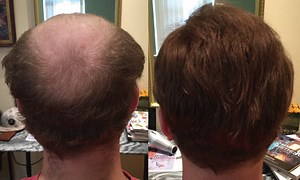 Male Pattern Baldness Solution