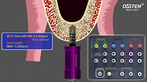 -CAS KIT(CRESTAL APPROACH SINUS KIT) by OSSTEM-HIOSSEN SISTEMA DE ELEVACION DE SENO POR ENTRADA CRESTAL, HACIENDOLO DE UNA MANERA FACIL RAPIDO Y SEGURO. CAS-DRILL FRESAS CON FORMA CONICA INVERSA LA CUAL RECOLECCTA HUESO EN LA PUNTA EVITANDO DAÑAR LA MEMBRANA ESTE TIPO DE FRESAS LOGRAN REALIZAR LA ELEVACION EN TIPO DE SENO PLANO, INCLINADO Y SEPTUM. SECUENCIA DE FRESADO GUIADA, LAS FRESAS TIENE UNA DURACION DE MAS DE 70 CIRUGIAS. SISTEMA UNICO DE STOPPERS QUE CONTROLAN LA PROFUNDIDAD MILIMETRO A 