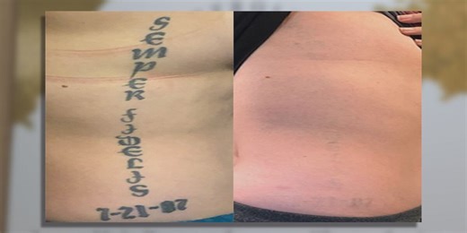 Hear first-hand what it’s like getting a tattoo removed
