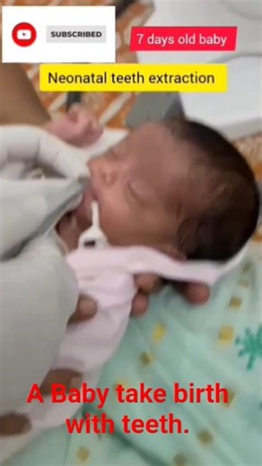 7 days old baby teeth extraction