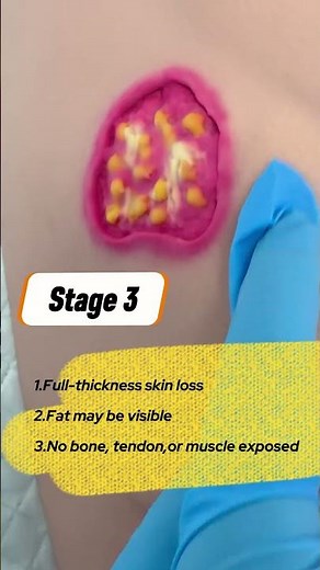 Can you identify the difference between Stage 2, Stage 3, and unstageable pressure injuries?
