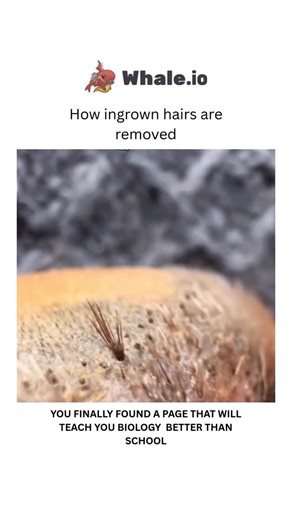 BIOLOGY | MEDICAL | HEALTH | Ingrown hairs occur when a strand of hair grows back into the skin instead of rising up to the surface. This can lead to small bumps,... | Instagram