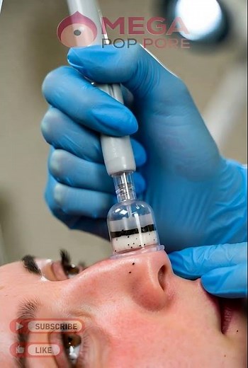 As a Dermatologist I Reveal the BEST Blackhead Removal Techniques
