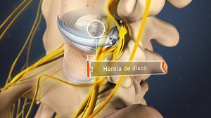 Inyecciones de esteroides epidurales lumbares para la lumbalgia y la ciática