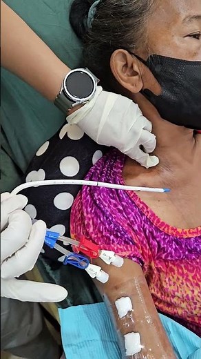 Removal of IJ (Intra Jugular) Catheter to dialysis patient