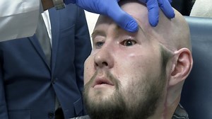 Surgeons have performed the world's first eye transplant