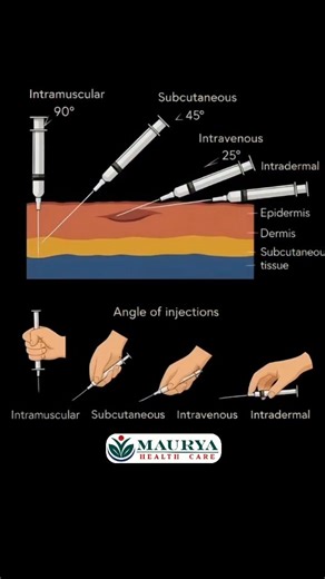 𝐌𝐀𝐔𝐑𝐘𝐀 𝐇𝐄𝐀𝐋𝐓𝐇 𝐂𝐀𝐑𝐄 🏥 on Instagram: "💉 Angle of Injection & Types (Simple Guide) Injection dene ka angle aur type sahi hona bahut zaroori hota hai, warna medicine ka effect kam ho sakta hai ya pain/injury ho sakti hai. 🔹 1️⃣ Intradermal (ID) Angle: 10–15° Layer: Skin ke just niche Use: BCG, Mantoux (TB test) Tip: Chhota needle, skin par bleb (chhota uभार) banta hai 🔹 2️⃣ Subcutaneous (SC) Angle: 45° (kabhi-kabhi 90° if fat zyada ho) Layer: Skin ke niche fat layer Use: Insulin,