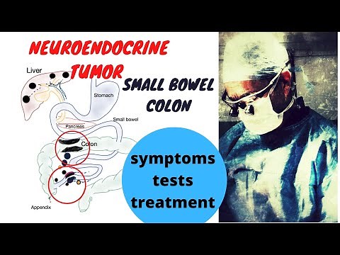 Neuroendocrine Tumor; Small Bowel and Colon