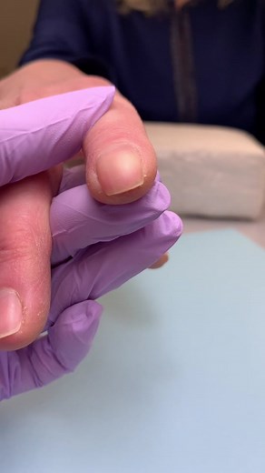 Clubbed nail transformation #nailtech #nailsartvideos #nailtechnician #nailtiktok #nailtechcheck #nailsalon #nailsoftiktok #beauty #beautyhacks #acrylicnails #coffinnails