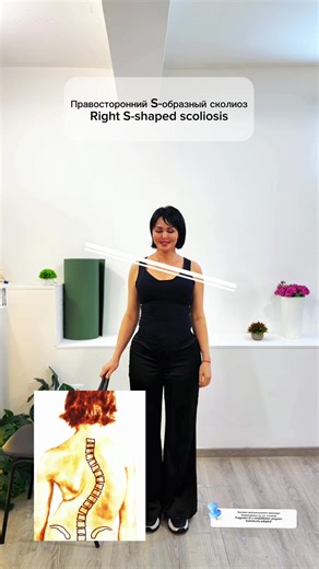 S-shaped scoliosis correction using the Asymmetric Method by Marina Ispiryan. This is a fragment of a rehabilitation program. The method is individually adapted depending on the type of scoliosis. We work with a specific type of scoliosis, muscle imbalance, pelvic position and thoracic spine correction. Real results. Individual correction. 📍 Online & offline treatment available worldwide 🌐 verginiacenter.com 📲 WhatsApp: 37498149914 #scoliosis #unevenhips #pelvictilt #spinecorrection #scoliosi