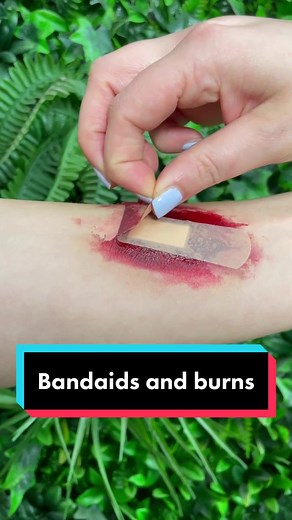 First Aid Tips for Burn Injuries