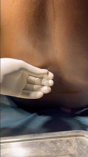 Spinal anaesthesia procedure #mbbs #doctors #hospital #sorts #sortvideo