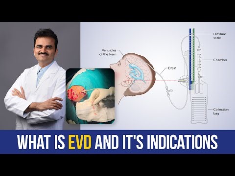 What is External Ventricular Drainage & it's Indications #premierhospitals #drravikumar #hyderabad