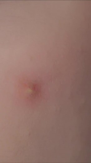 DIY Pimple Removal with Toothpaste