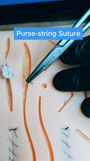 Purse-String Suture: Uses and Techniques