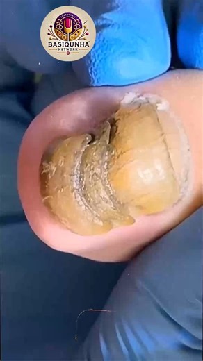 Smart Health Tips for Thickened Toenails That Prevent Complications #SafeSteps #DiabeticFootCare #FootCareTips | Basiquinha