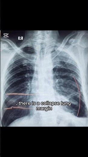 Collapsed lung margin of pneumothorax. #shorts #foryou