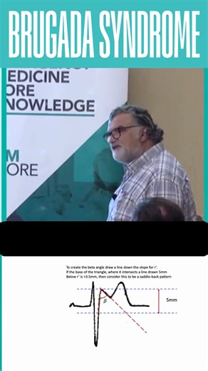 Dr Peter Kas on Instagram: "A simple way to diagnose Saddle-Back BRUGADA Syndrome....Just calculate the beta angle. 💡Brugada is a Na channel abnormality that can lead to polymorphic VT. When the arrhythmia stops, its called syncope, when it continues, it's cardiac arrest. For more emergency medicine knowledge and tips follow us @emcoreshow_ or join us at one of our 2026 international conferences, or Cardiac Bootcamps. #emergencymedicine #ecg #criticalcare #medicaleducation #resuscitation #medic
