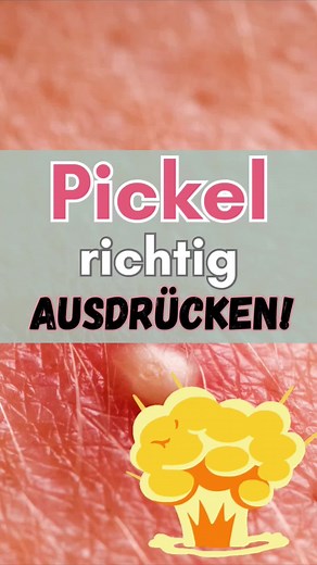 💣 Wie man Pickel richtig ausdrückt: Wenn du es nicht lassen kannst und es ausdrücken musst, dann achte darauf, dass du es auf die richtige Weise machst. Verwende keine Fingernägel, sondern greife stattdessen auf ein sauberes Wattestäbchen zurück, um den Pickel auszudrücken. Vergewissere dich auch, dass deine Hände sauber sind. Machst du diese „reifen“ Pickel weg oder lässt du sie einfach da? #Pickel #Hautpflege #Akne #Beauty #Gesichtspflege #Pickelausdrücken #Hautprobleme #Skincare #Gesundehaut