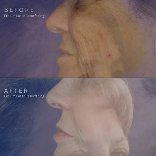 Erbium Laser resurfacing