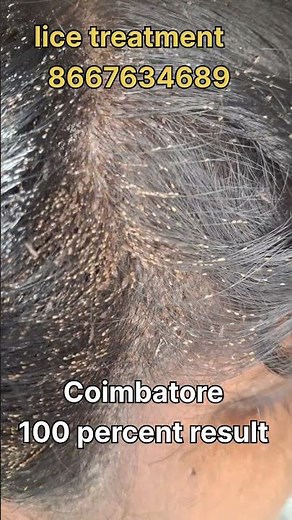 How to remove nits and lice #hair#coimbatore#haircare#eeru#peenu#lice#hairproblem#nitsremoval#nits