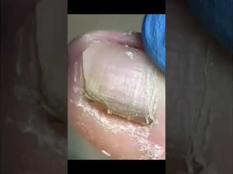 From Pain to Relief – Super Satisfying Toenail Fix | Nail ASMR