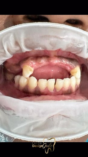 Incredible Dental Transformation! 💫✨ 🦷💖 In our latest case, we had a patient who wanted to regain their confidence and have a dazzling smile. We worked as a team to achieve a spectacular result, and we couldn't be happier with the outcome. 💪💯 We combined a hybrid denture on the upper arch and crowns on the lower arch to achieve a perfect and natural-looking smile. The patient was thrilled with the result, and their satisfaction is our greatest reward. 🌟 There is nothing more rewarding than