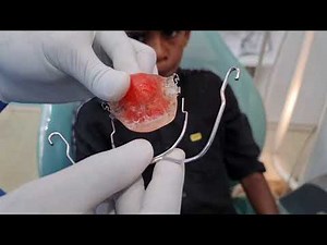 headgear activator combination