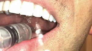 11K views · 37 reactions | Tonsil Stone Kit: https://amzn.to/2zpmCVQ...