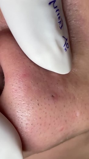 #trend_barbershop #skincare #تنضيف_بشر #رؤوس_سوداء