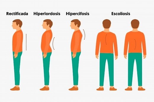 Columna desviada: tipos, síntomas y tratamiento