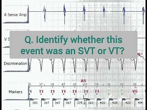 Device interrogation quiz ll VT or SVT?